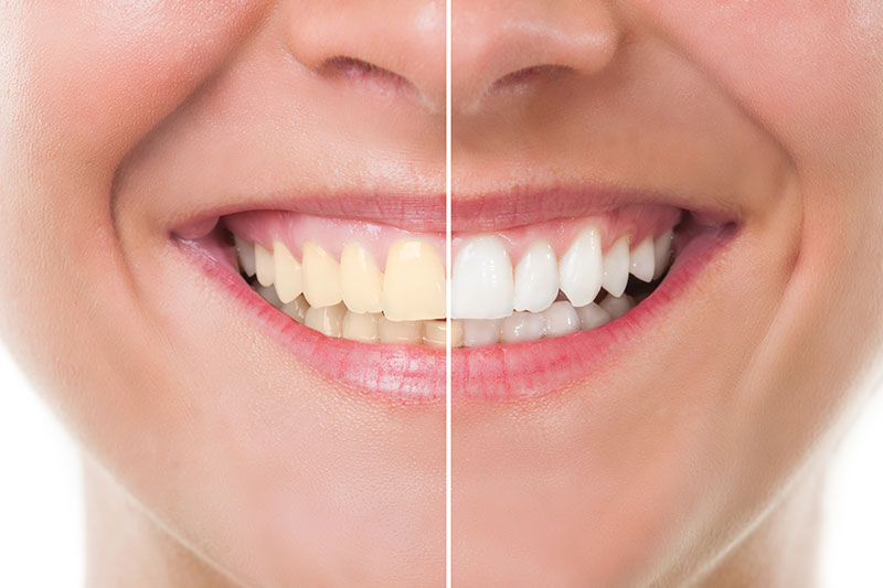 teeth whitening mar vista