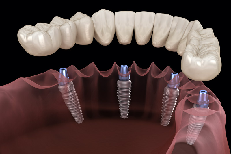 Implant Dentist Los Angeles and Beverly Hills