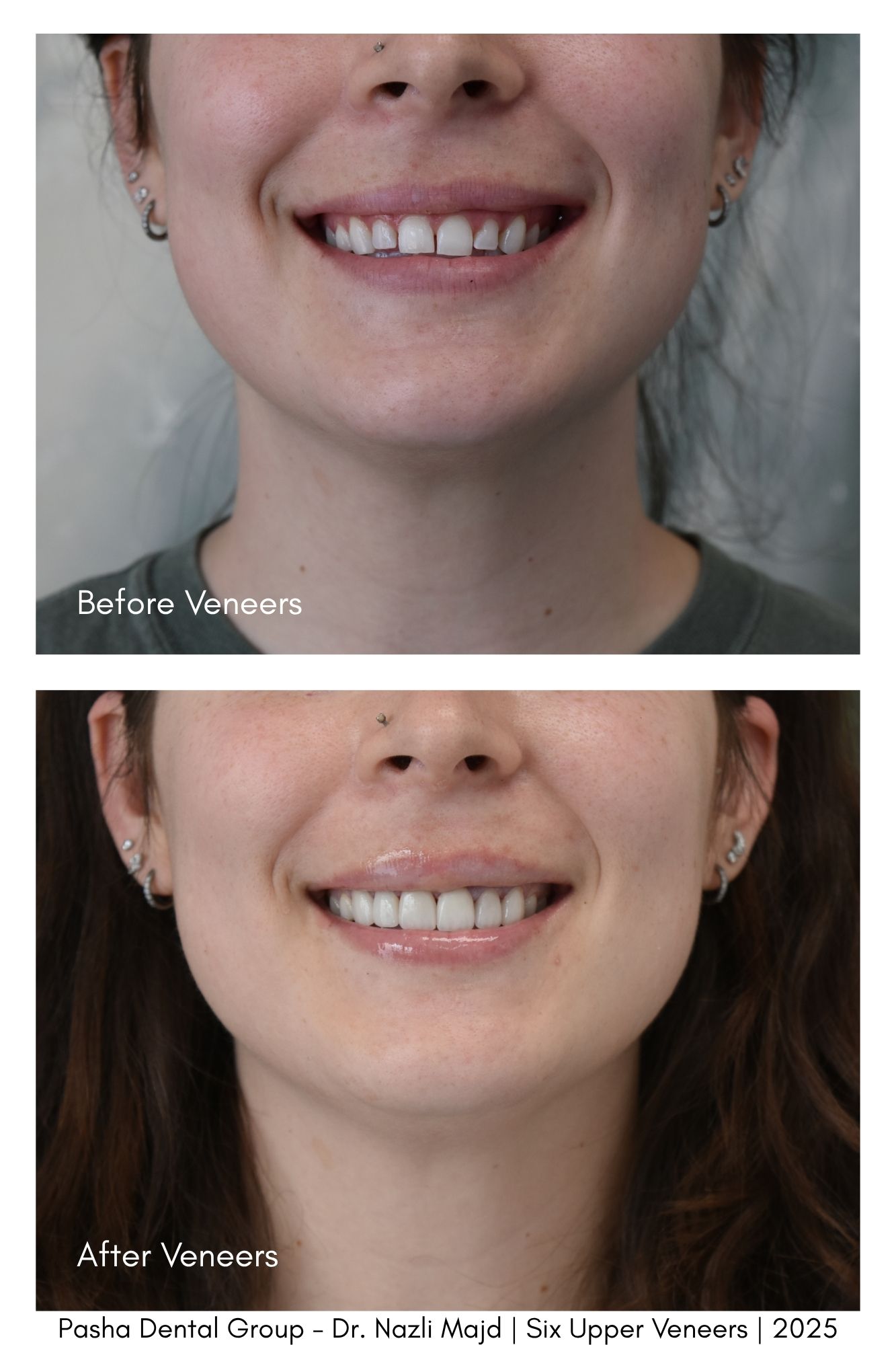 Veneers Mar Vista Los Angeles