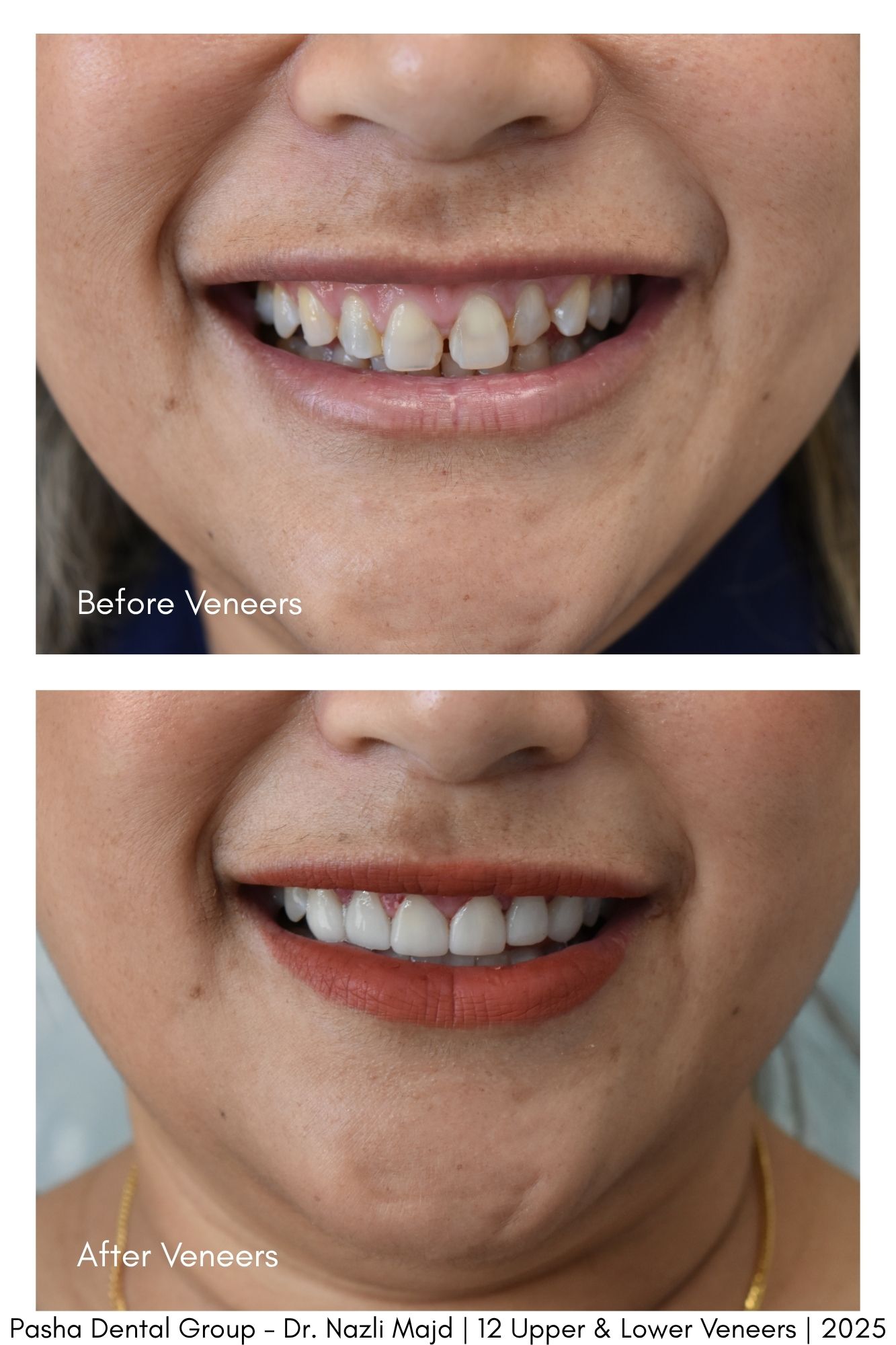 Veneers Mar Vista Los Angeles