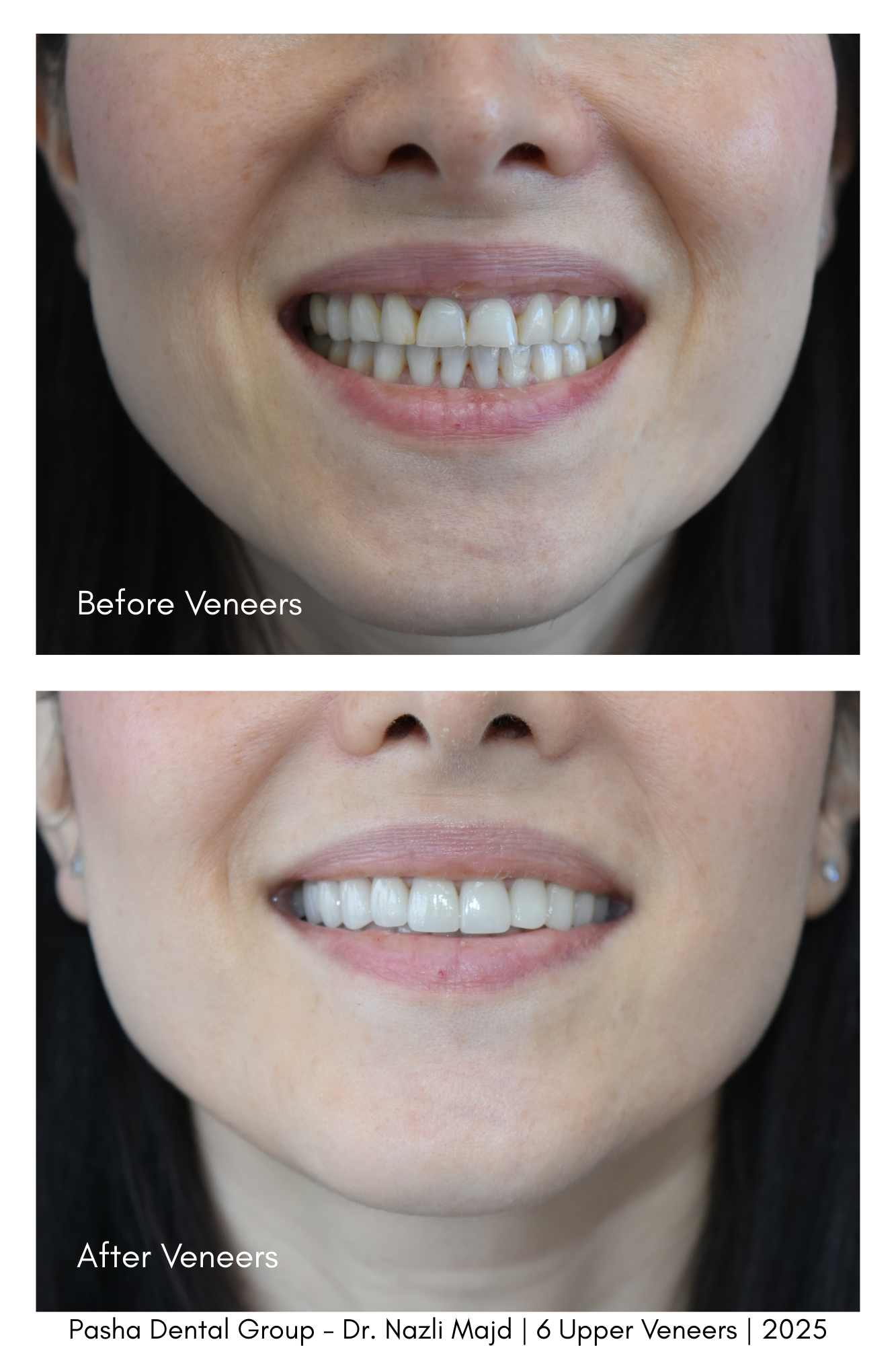 Veneers Mar Vista Los Angeles