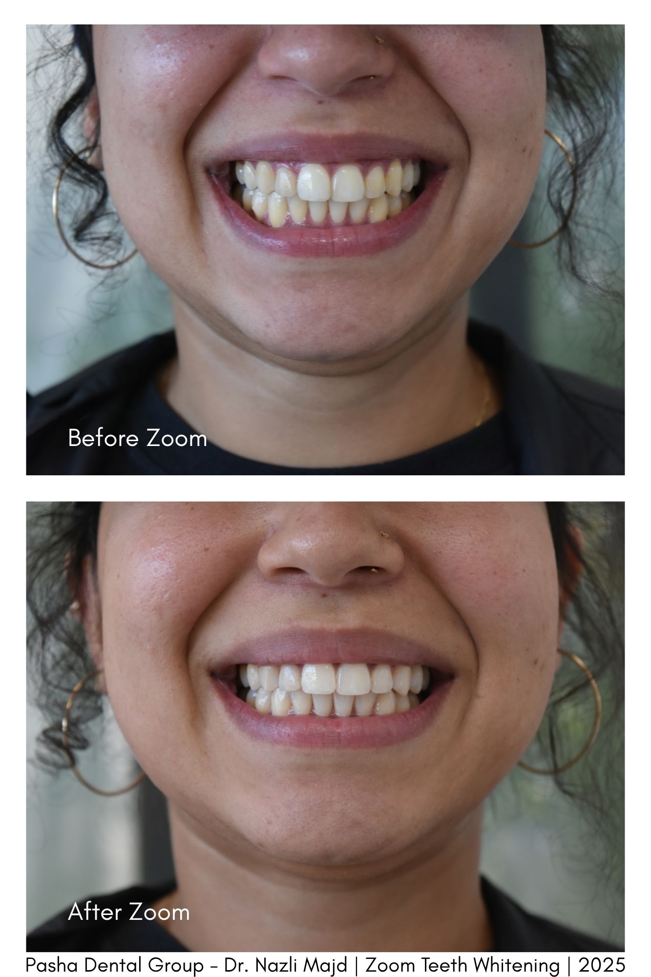 Teeth Whitening  Mar Vista Los Angeles