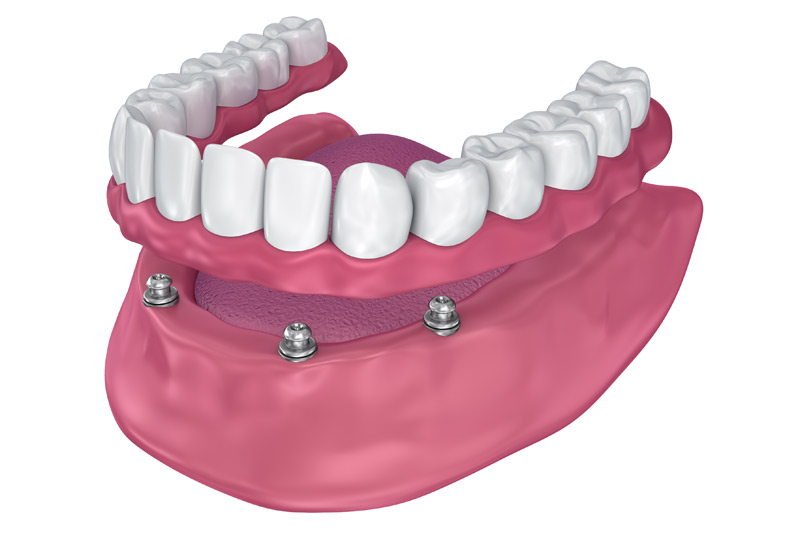 Implant Dentist Los Angeles and Beverly Hills