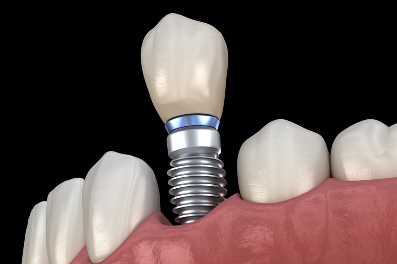Implant Supported Dentures Los Angeles
